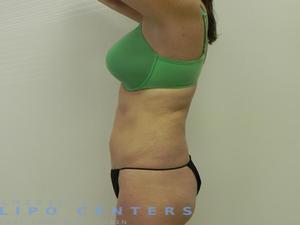 americanlipocenters_193.jpg